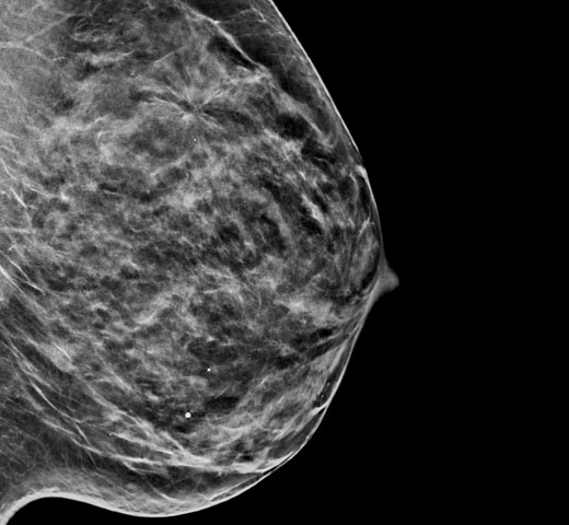 Hologic C-View™ synthetisches 2D-Bild auf weißem Hintergrund