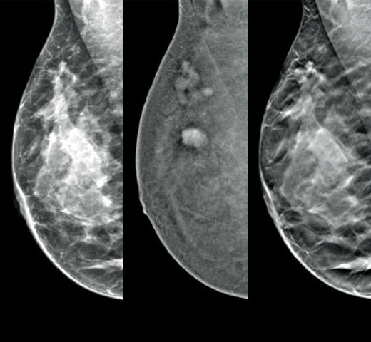 Hologic I-View™ Kontrastverstärkte Bildgebung