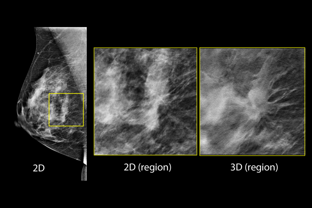 Klinische Aufnahmen einer Brustuntersuchung mit verdächtiger Läsion