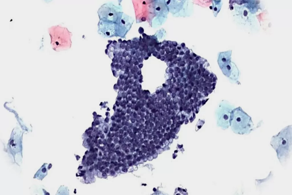 Pap-Test-Scan: Negativ mit Gebärmutterhalszellen