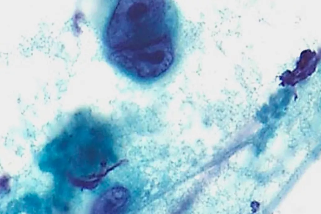 Hodgkins-Lymphom, FNA vom Hals, Papanicolaou-Färbung