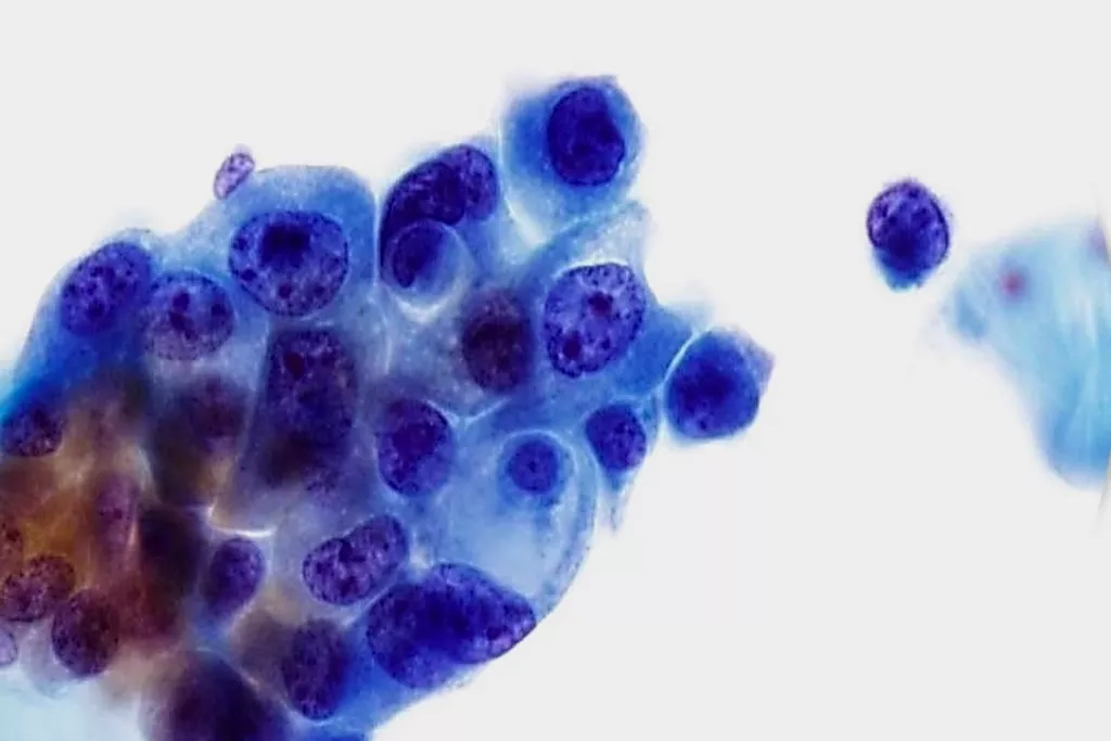 Übergangszellkarzinom, Grad 3, Urin, Papanicolaou-Färbung