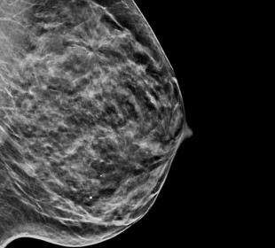 Hologic C-View™ synthetisches 2D-Bild auf weißem Hintergrund