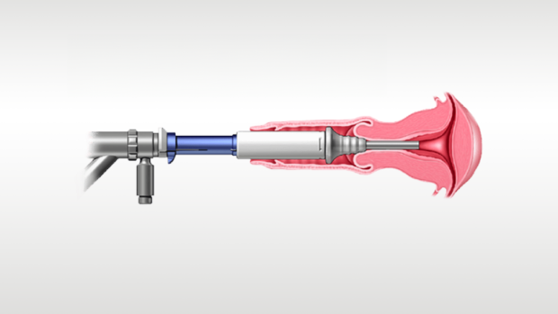 Abbildung eines Medizinprodukts beim Einsatz.